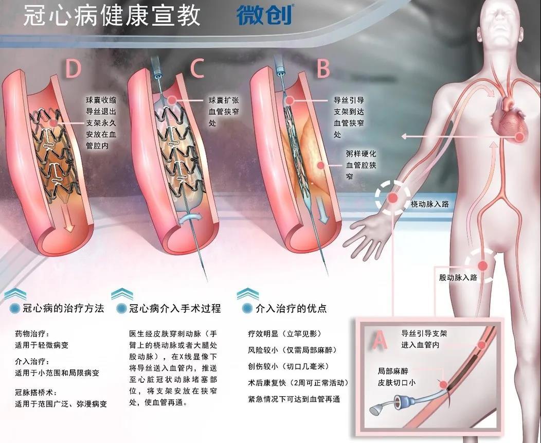 关于支架常见的6大问题，答案都在这！_医学界-助力医生临床决策和职业成长