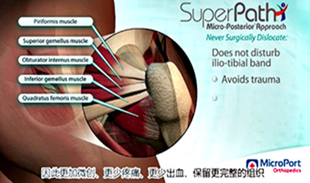 SuperPATH®, SuperCap®, Path®手术入路